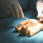 cirugia de la mano valencia