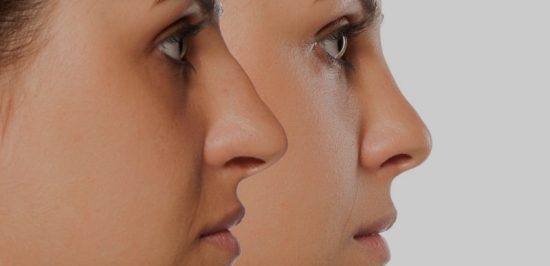 comparative portrait of a young woman before and after nose correction